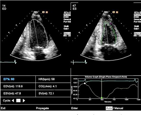 ef on echocardiogram stands for.